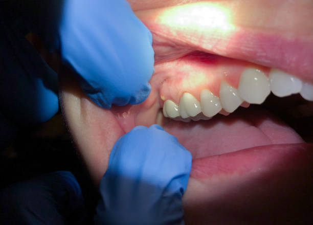 Best Urgent Care for Lost Fillings or Crowns in North Zanesville, OH